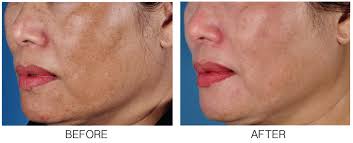 Image result for Melasma