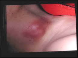 In some cases, a delay may be due to medical negligence. Tuberculosis Cancer Therapy Advisor
