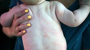 'psoriases' is a 9 letter word starting with p and ending with s. How Psoriasis Affects The Youngest Patients Everyday Health