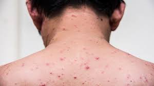 After the virus of chickenpox gets to enter into your body then the symptoms get appear after 10 to 21 days. Cacar Monyet Gejala Penyebab Dan Mengobati Alodokter