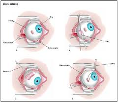 Whether the tear creates a blind spot is dependent upon its size and. Scleral Buckling Procedure Recovery Removal Pain Complications Time Infection Medication