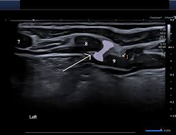 Slipping Rib Syndrome Rib Injury Clinic