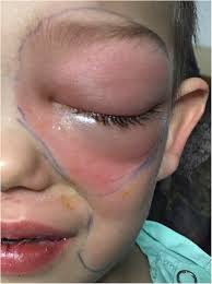 Image result for phlegmon on face)