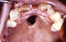 No, gonorrhea is a bacterial infection and requires treatment with antibiotics. Oral Stds Pictures Types Symptoms Treatment And Prevention