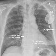 Learn vocabulary, terms and more with flashcards, games and other study tools. File Labelled Ddd Icd Jpg Wikipedia