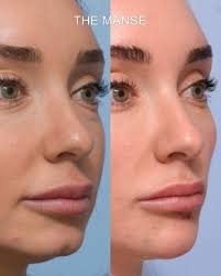 A recessed chin refers to when a chin is positioned more horizontally backwards than desired. Chin Filler Best Clinic Sydney For Dermal Fillers