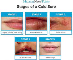 Both types of sores tend to heal on their own within 2 weeks. How Long Do Cold Sores Last Stages Pictures And Treatments