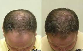 Rehair Laser Hair Growth Cap Laser Cap For Hair Loss Hair Laser Growth Hair Growth System Laser Hair Treatment