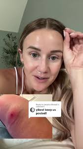 Replying to @Jessica Breault cellulitis update 💛🥲 #cellulitis #greenscreen