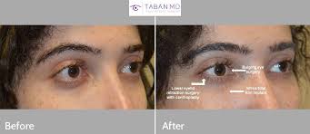 Lifting the corner of the eye with out surgery. Before And After Canthoplasty Photos Mehryar Ray Taban Md