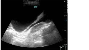 Reviewed by arefa cassoobhoy, md. Sonographic Evaluation Of Pleural Effusion