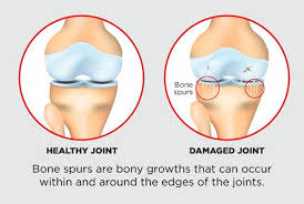 Check spelling or type a new query. Protect And Nurture Your Joints To Prevent Bone Spurs Southern Hills Hospital Medical Center