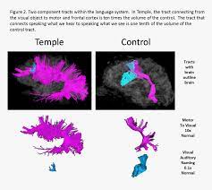 However, they had average or above average Brain Outline Png Png Download Asperger Syndrome Brain Scan Transparent Png Transparent Png Image Pngitem