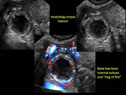 Image result for corpus luteum sonography)
