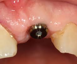 Aici gasesti medicamente pentru durere, analgezice, durere de cap, de gat, de masea, de stomac, de burta dar si alte adjuvante pentru nevoile tale. Dureri De Dinti Cauze Simptome Complicatii Clinica De Stomatologie Dental Progress