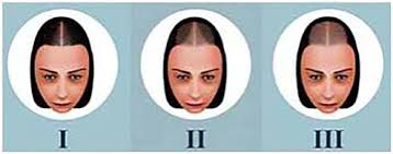 There are a lot of treatments out there that target male pattern baldness. Female Pattern Hair Loss A Clinical Pathophysiologic And Therapeutic Review Sciencedirect