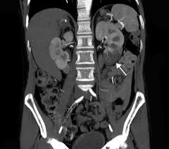 Image result for Renal Infarction