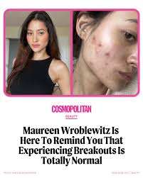 Here's a reminder that everyone gets them—even our fave celebs, models, and  influencers like #MaureenWroblewitz. #FromTheArchives Know more in the  comments.