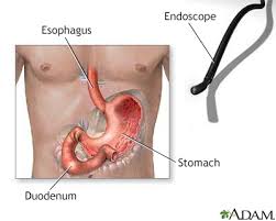 Upper endoscopy is a minimally invasive procedure that uses an endoscope to examine the upper gastrointestinal tract—the esophagus, the stomach, and the first eat soft foods or liquids for the first meal or two after endoscopy. Egd Esophagogastroduodenoscopy Information Mount Sinai New York