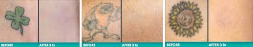 Tattoo removal tips at home. The Best Laser Tattoo Removal Center In Michigan Skin And Vein Center