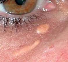 Image result for xantelasma