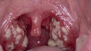 Rosu in gat este una din cele mai frecvente boli intalnite mai ales in lunile reci ale anului. Studiu De Caz Durerea De Gat Alerta Orl