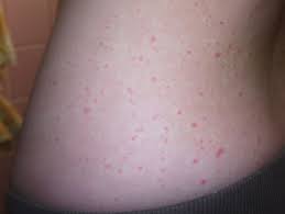 Also called scarlet fever, a disease caused by infection with group a streptococcal bacteria that occurs in a small proportion of people with strep throat. Scarlattina Adulti Terapie Malattia Infettiva