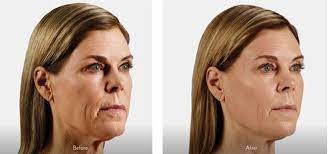 Dermal Fillers In Santa Barbara Facial Fillers Juvederm Injections Dermal Fillers Facial Fillers Face Fillers