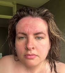 I have eczema and sensitive skin. Can someone recommend a face wash that  doesn't give me this reaction? 🥺 I can't work out if it's just my skin  being sensitive to this