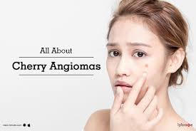 Cherry angiomas are not harmful and hence they do not require any treatment at all, except for cosmetic reasons. All About Cherry Angiomas By Dr S K Kashyap Lybrate