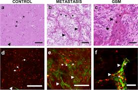 Ce dispositif de promotion professionnelle, destiné aux personnes peu qualifiées ou non diplômées vise à attester de. Real Time Brain Tumor Imaging With Endogenous Fluorophores A Diagnosis Proof Of Concept Study On Fresh Human Samples Scientific Reports