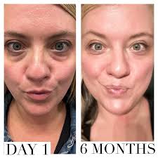 How to reduce puffy morning eyes?