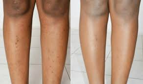 This is the next ingredient which helps to cure hair bumps. How To Remove Dark Spots On Legs Fast Naturally Kobo Guide