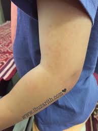 Saya tinggal di kawasan perumahan rumah teres. Bila Anak Kesayangan Sendiri Disahkan Positif Denggi Diari Ibuzarith