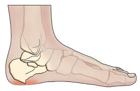 Dental bone spurs (also known as bone spicules) are small bone pieces that become dislodged from the surrounding tissue but are still trapped in your gums. Can Bone Spurs Grow Back Azalea Orthopedics