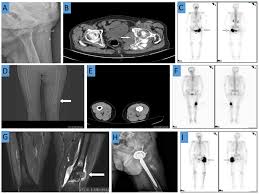 Primary Osteosarcoma In Elderly Patients A Report Of Three Cases