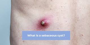 Image result for Cyst