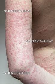 Image result for Polymorphous Light Eruption