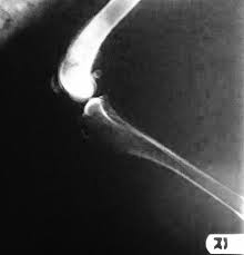 And others will continue to live comfortably for months on end. No Bones About It Osteosarcoma Is A Bad Bone Cancer Creature Comfort Care Llc