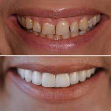 Qualitat Trifft Zahnasthetik Veneers Dusseldorf