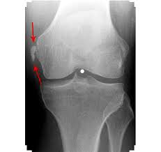 Medial in anatomy means toward the midline of the body, as opposed to lateral, or toward the sides of the body. Pellegrini Steida Syndrome A Cause Of Stubborn Medial Knee Pain