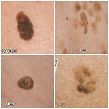 It can be the result of sunlight, genetics, or age and will not usual need to be treated. Mimics Of Skin Cancer I Skin Cancer 909
