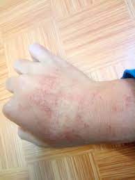 We did not find results for: Skin Concerns Does Anyone Get These Kind Of Skin Rash On Cold And Dry Winter Days And How To Clear It I Have On Both Hands Skincareaddiction