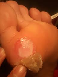I Ve Been Getting Bad Blisters On My Foot Is There A Way To Prevent Treat This Badminton