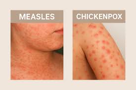 Image result for measles