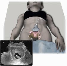 Image result for First Trimester Ultrasound