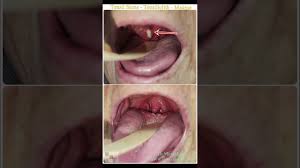 Image result for Tonsillolith