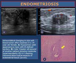 Ecr 2013 C 1867 High Resolution Ultrasound In The Assessment Of Soft Tissue Tumors And Tumor Like Lesio Ultrasound Medical Ultrasound Ultrasound Sonography