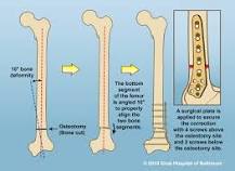 Internal Fixation: Plates | International Center for Limb ...