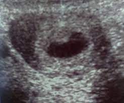 Leere Fruchthohle Schwangerschaftsgruppe Seite 3 Babycenter